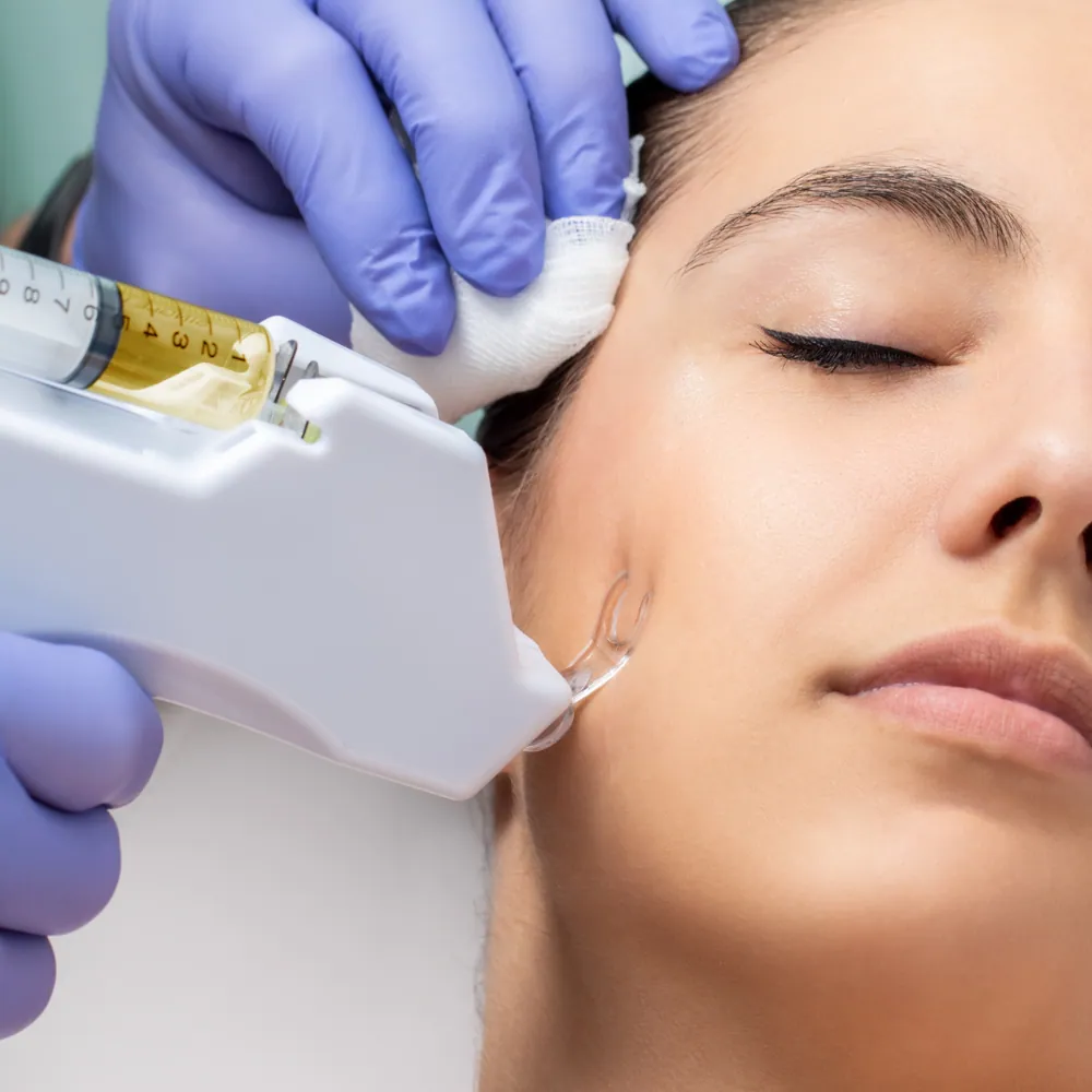 Microneedling-Behandlung im Gesicht